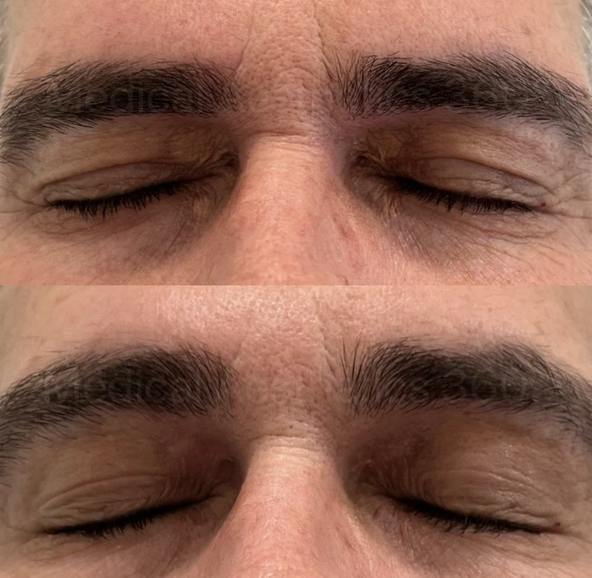 Two close-up shots of a man's eyes with eyebrows shown one above the other: top image with a furrowed brow and closed eyes, bottom image with relaxed brows and closed eyes, illustrating a before/after comparison.