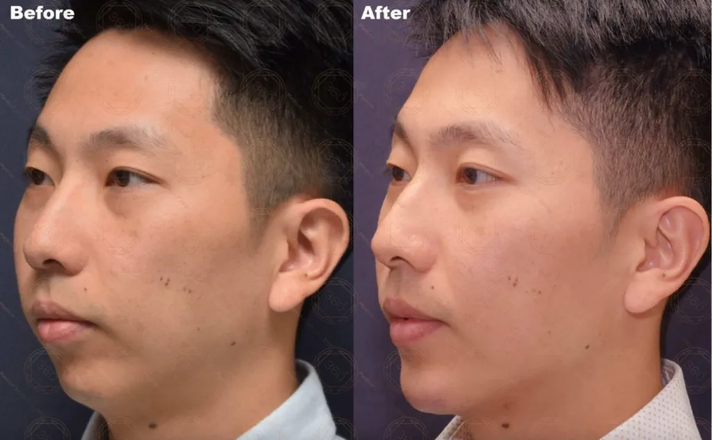 A Better Angle in Photos: Subtle Chin Projection for a More Balanced Look