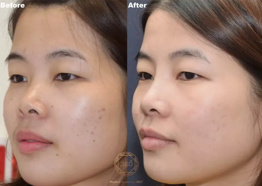 A Higher Bridge, A More Refined Profile: Subtle Nasal Enhancement with Careful Assessment