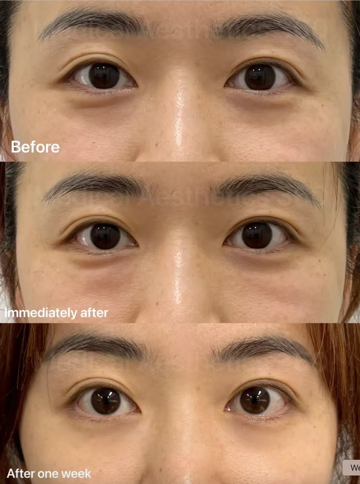 Under-Eye Rejuvenation in a Woman in Her Early 30s with Biostimulator and Rejuran
