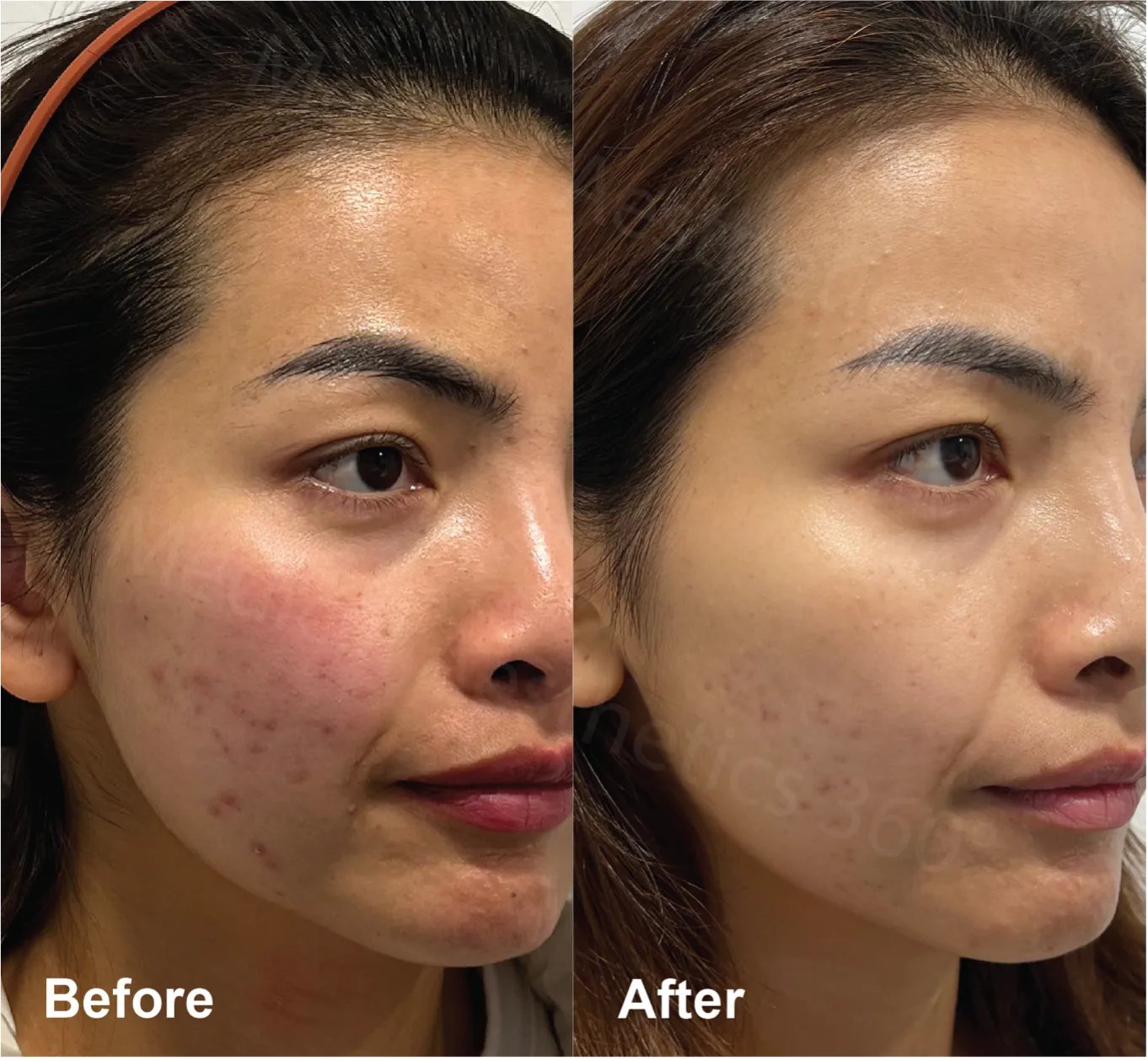Calmer & Clearer Skin — Regaining Balance After Acne Breakouts
