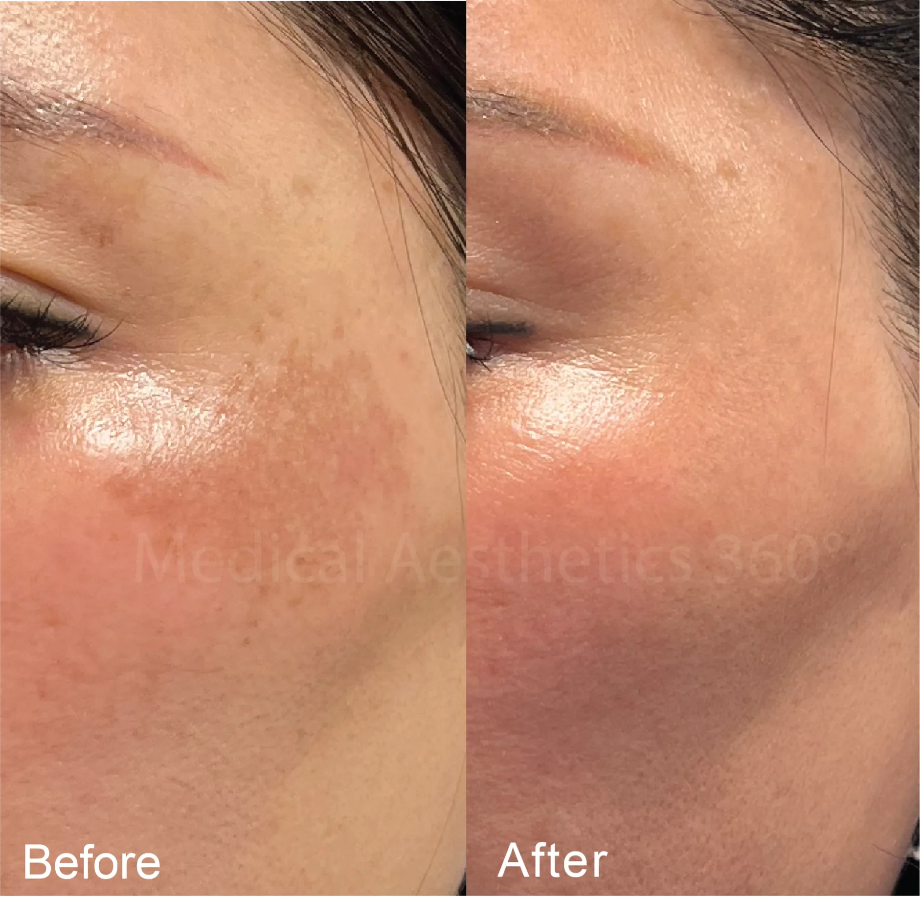 Restoring an Even Glow from Melasma