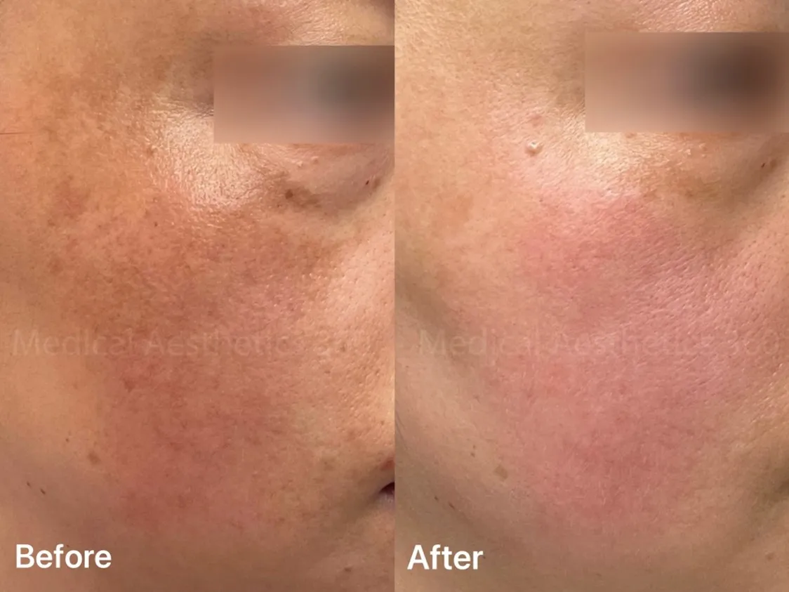 Clearer Days Ahead — Overcoming Persistent Melasma