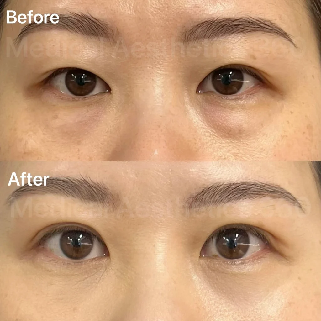 Before and after close-up of a woman's eyes and eyebrows, showing fuller, more defined brows after treatment.
