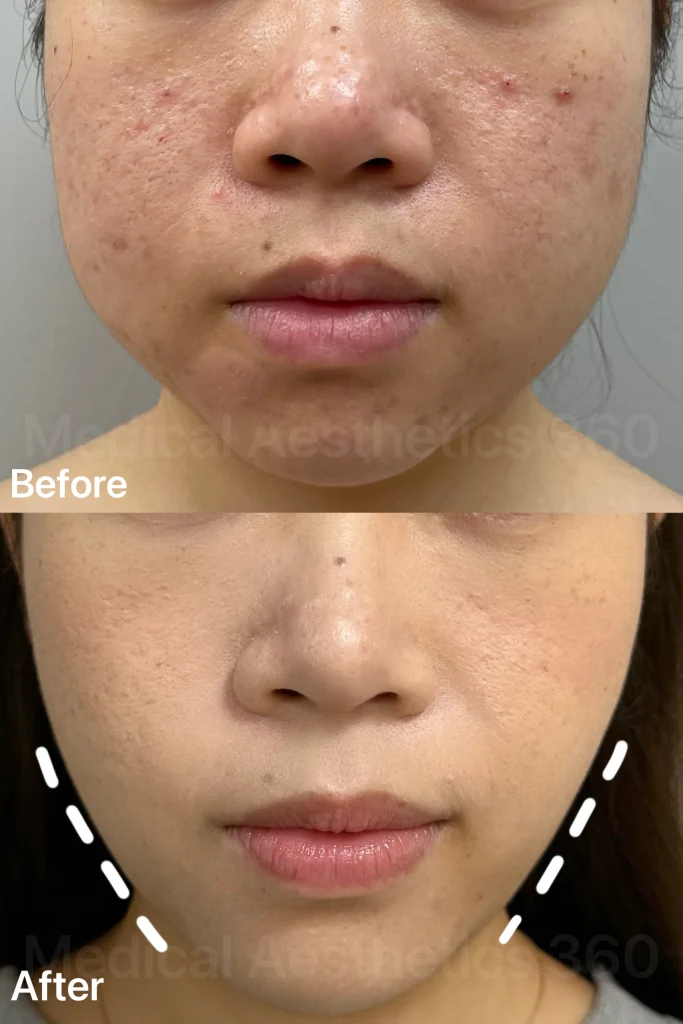 Split-view comparison: before has acne-prone cheeks with redness; after shows smoother, clearer skin along the jawline and chin.