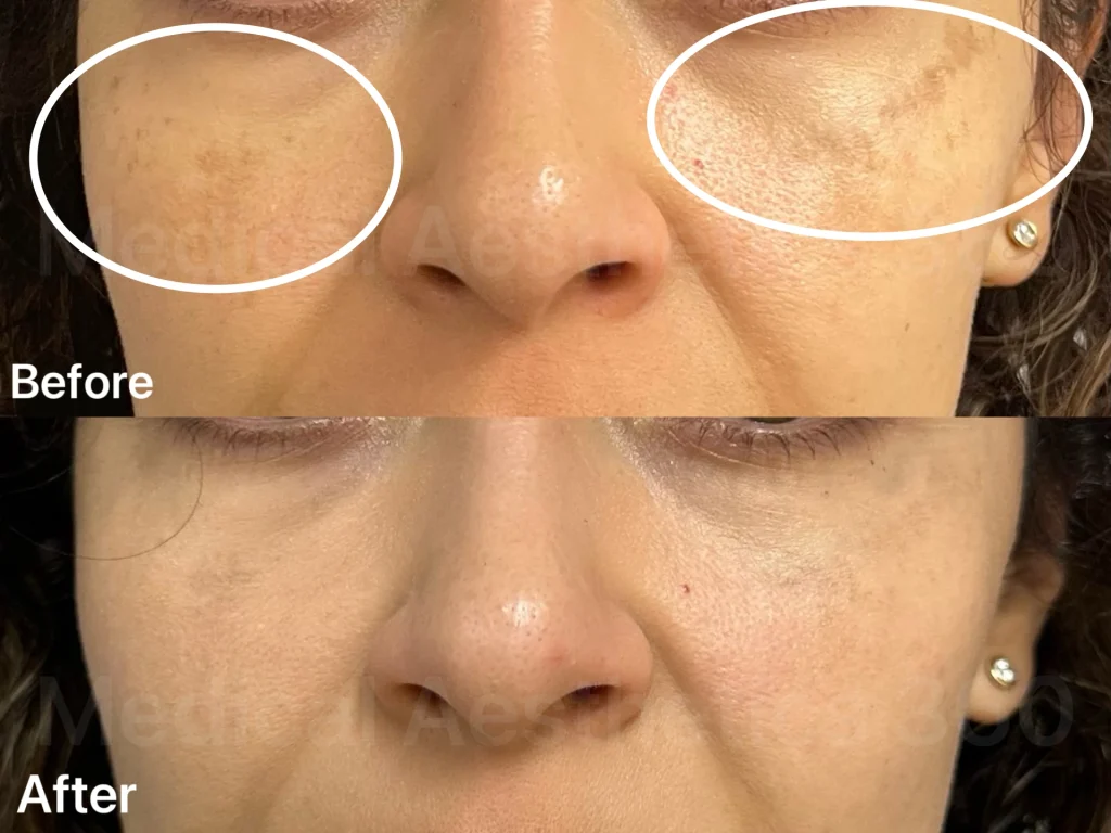Close-up of a woman's cheeks and nose showing skin texture before (top) and after (bottom) treatment, with 'Before' and 'After' labels visible.