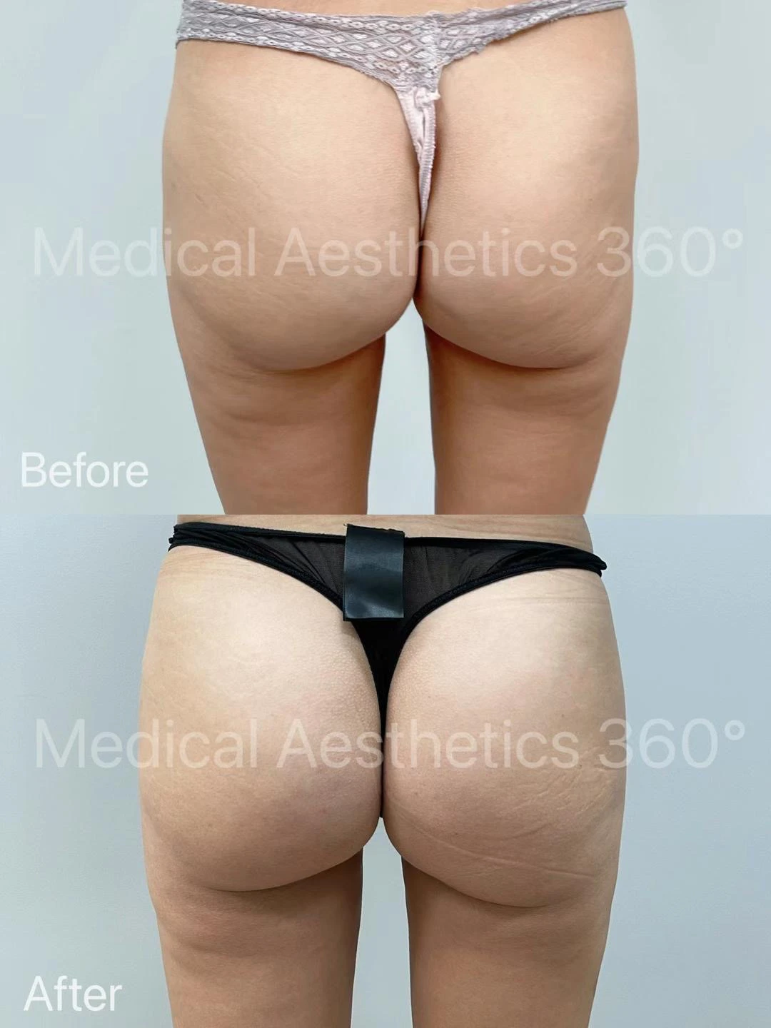 Medical Aesthetics 360 before and after buttock contouring case study