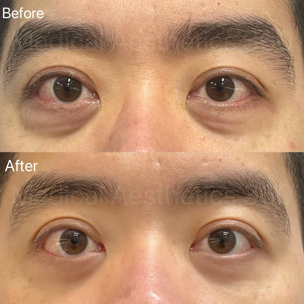 Close-up of a person’s eyes and brows with 'Before' text, showing natural eyebrows and facial skin for a cosmetic comparison