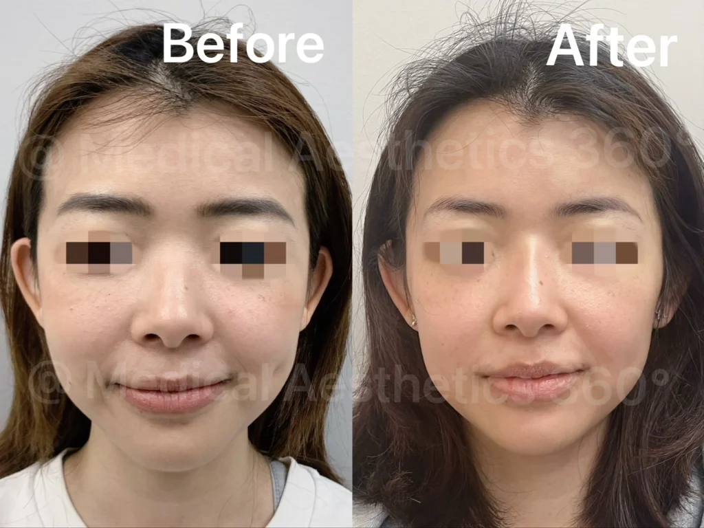 Side-by-side photos showing a woman's face before and after cosmetic treatment, demonstrating smoother skin and more even tone in the after image.
