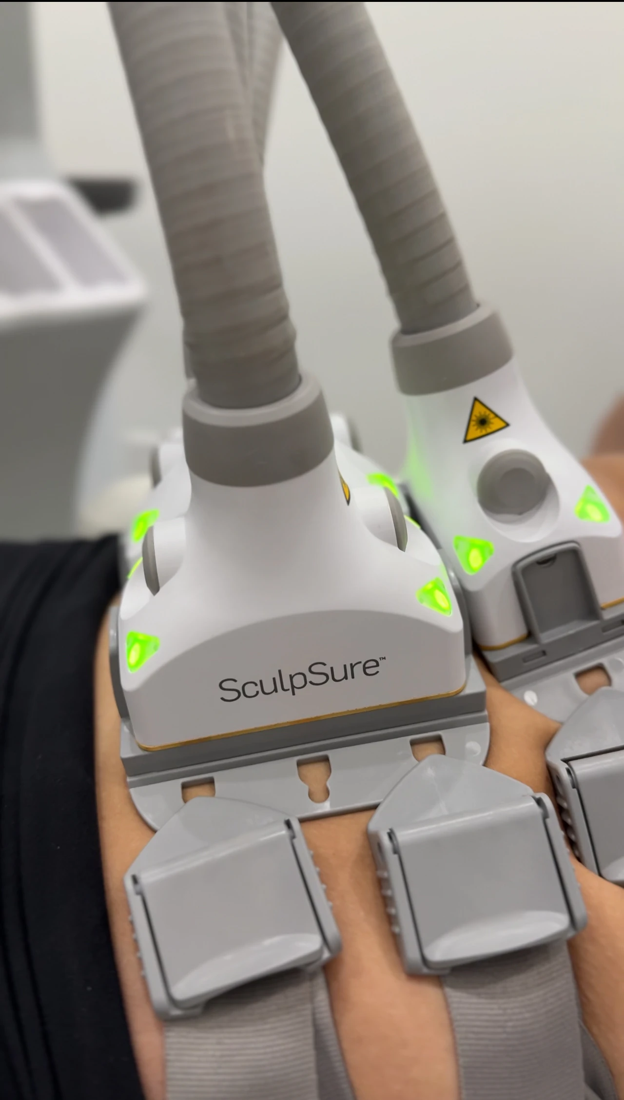 Close view of SculpSure laser applicators secured over the treatment area