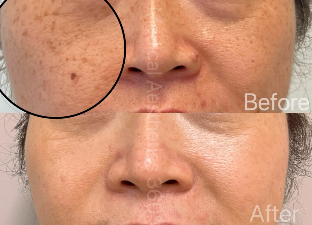 Close-up of a woman’s cheek with many freckles and rough skin on the left; the right side looks smoother (before/after)./nMore than one side shows a before-and-after skin treatment effect.