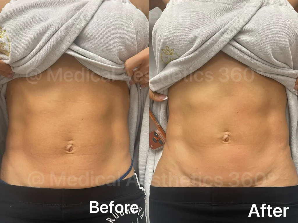 Before and after abdominal contouring case combining Venus Legacy with Emsculpt
