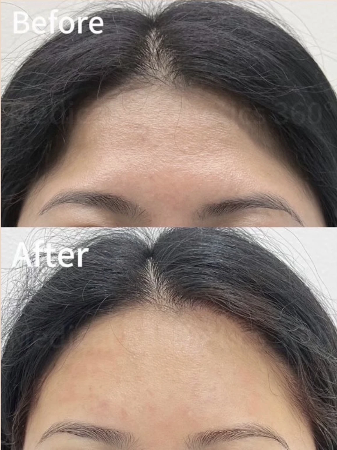 Forehead contour before-and-after clinical image supplied by Medical Aesthetics 360