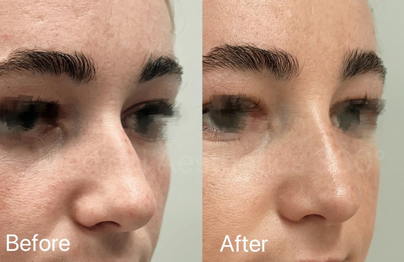 Before and after oblique views of non-surgical nose bridge and contour refinement