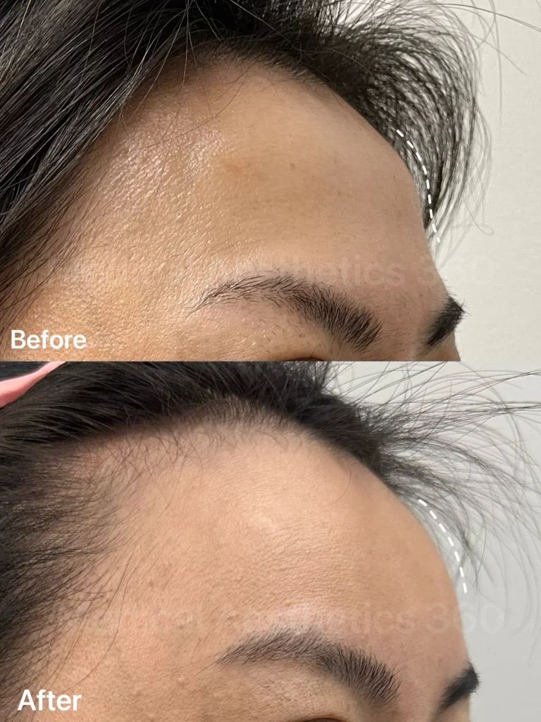 Close-up of a person’s forehead showing improved skin texture in the after panel, with ‘After’ text visible in the corner and a before panel above.