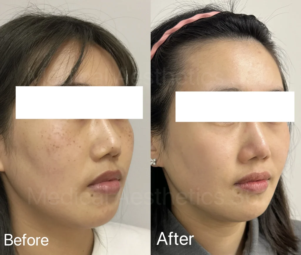 Before-and-after side-by-side close-up of a woman's face; left shows freckles and uneven skin tone, right shows smoother, more even complexion after treatment.
