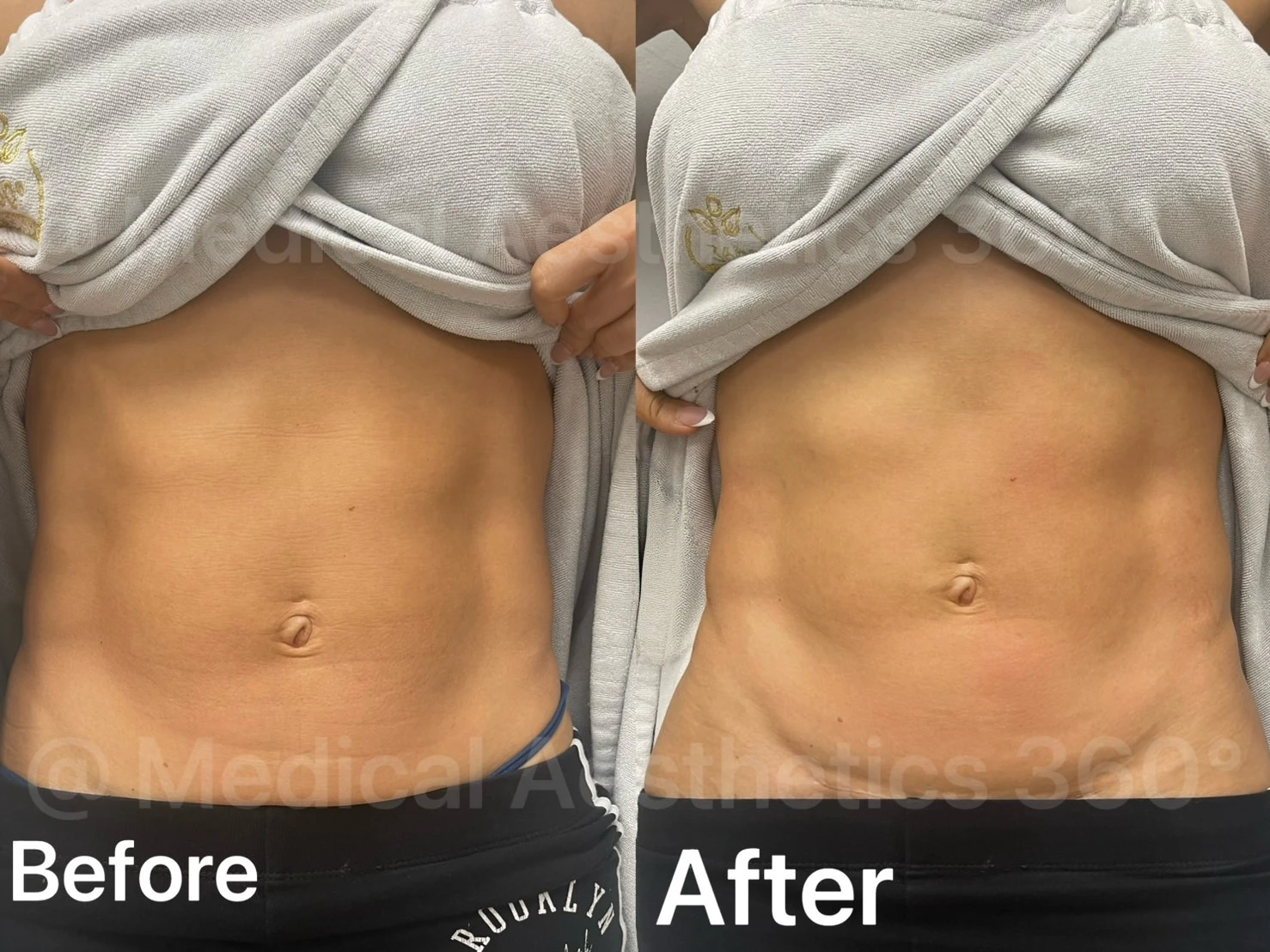 MA360 body treatment planning example