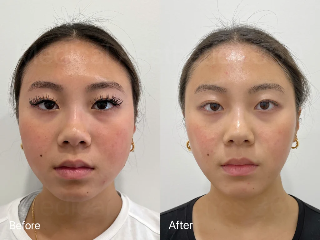 Two-panel image comparing a woman's face: left shows 'Before' with uneven skin tone and visible pores, right shows 'After' with smoother, brighter skin.