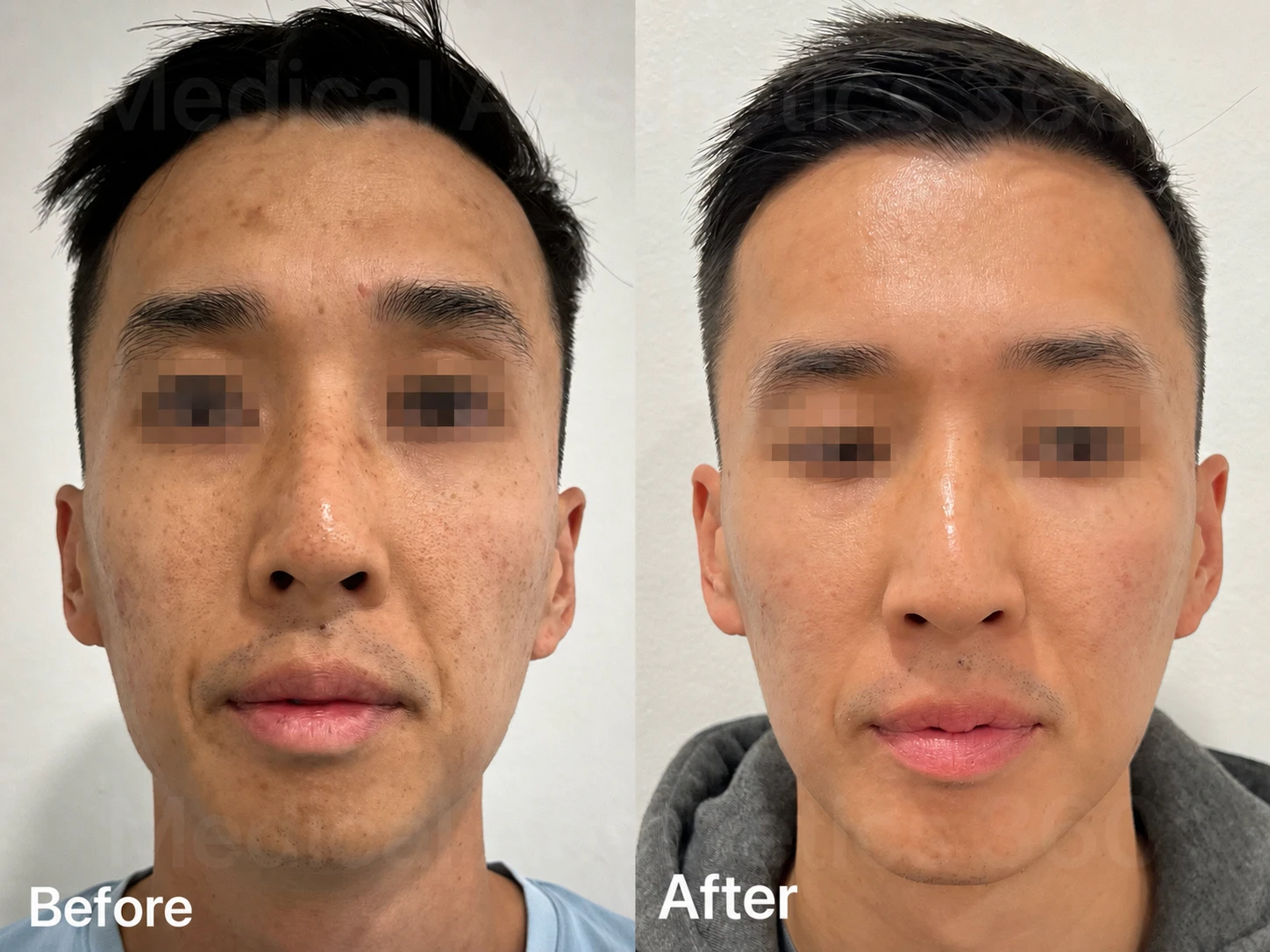 Pore minimisation and skin texture improvement before-and-after example at Medical Aesthetics 360