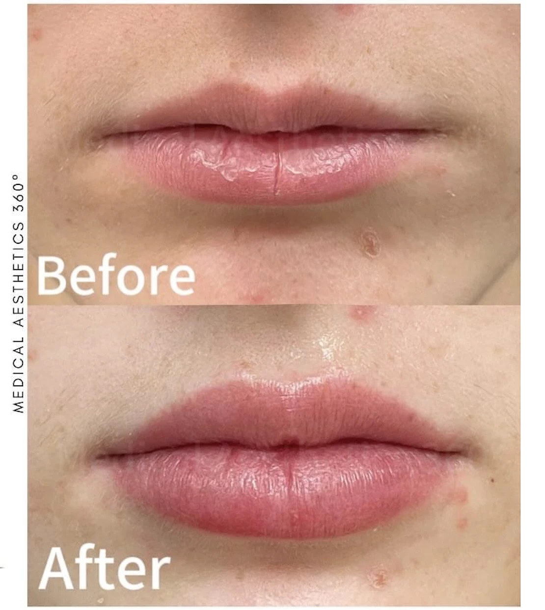Before and after composite from an MA360 lip enhancement case