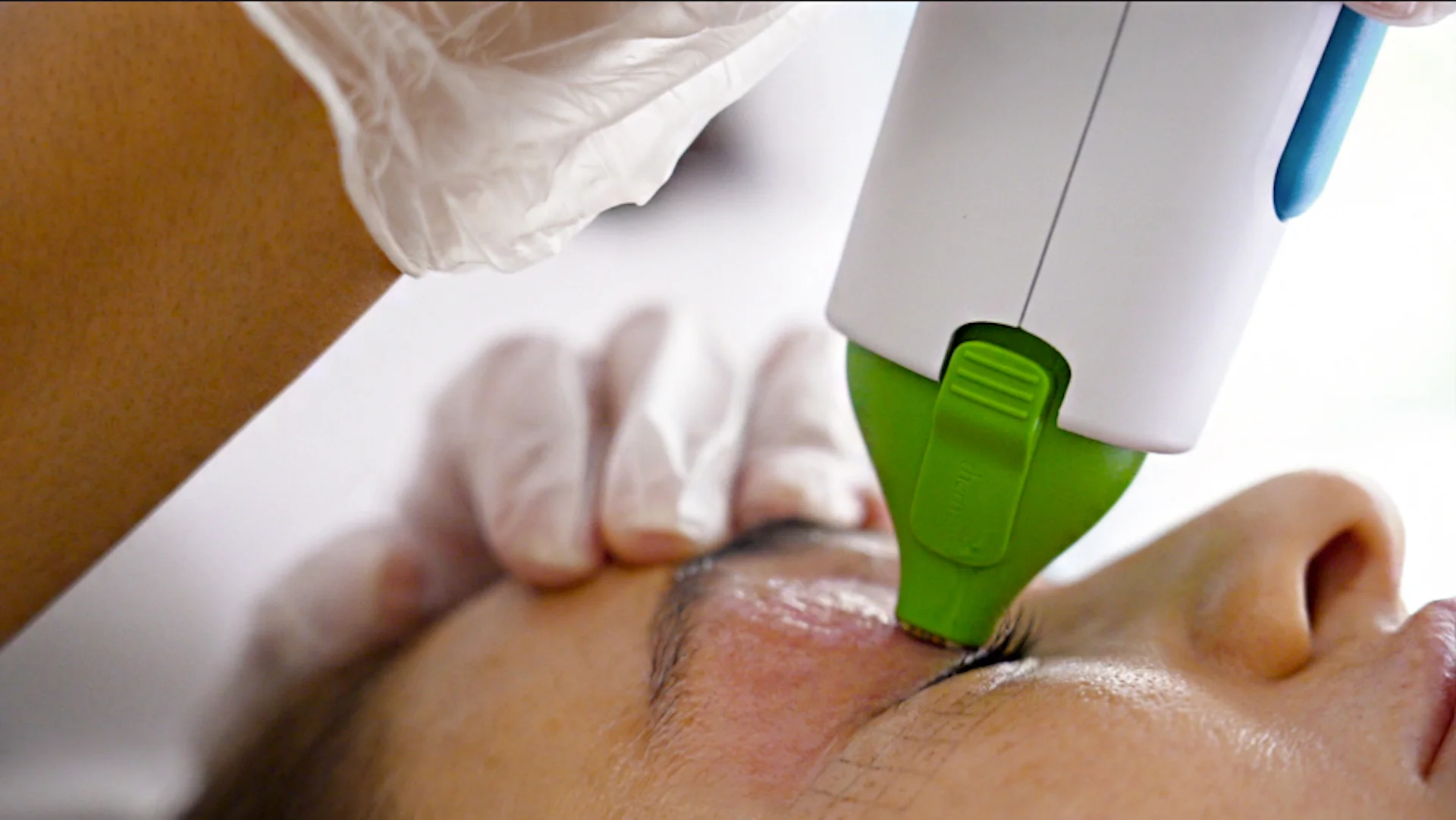 Thermage FLX for eyes and non-surgical eye area rejuvenation in Sydney