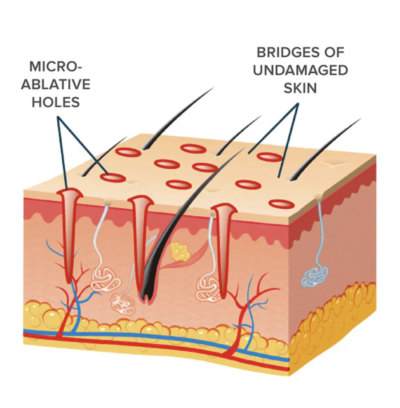 Diagram showing fractional laser microcolumns and surrounding untreated skin