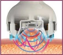 Diagram of multipolar radiofrequency energy and suction reaching different tissue depths