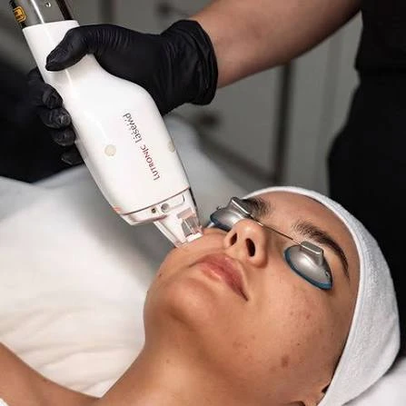 LaseMD handpiece treating the cheek with protective eye shields in place