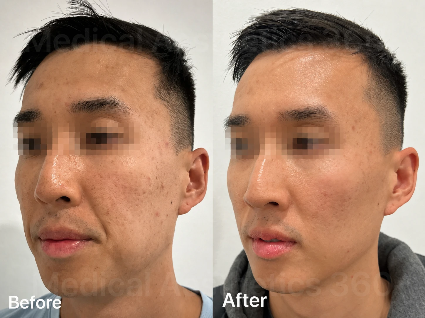 Morpheus8 pores and skin texture before-and-after patient example at Medical Aesthetics 360