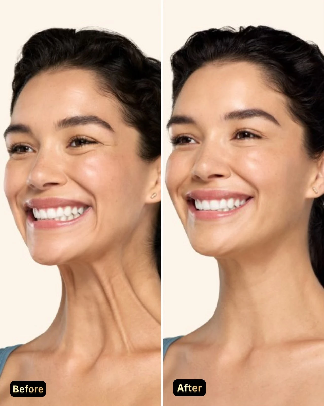 Supplied illustrative before and after comparison showing visible vertical platysma neck bands