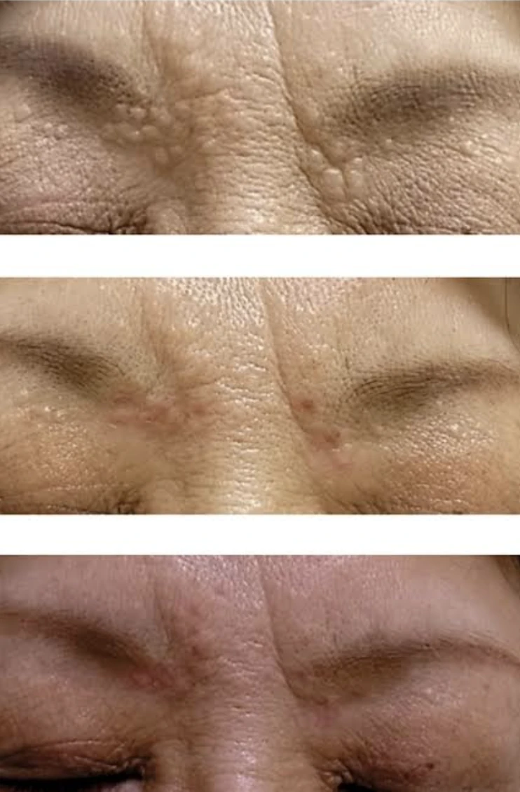 Three-stage clinical photograph showing syringoma treatment around the eyelids with Erbium YAG laser