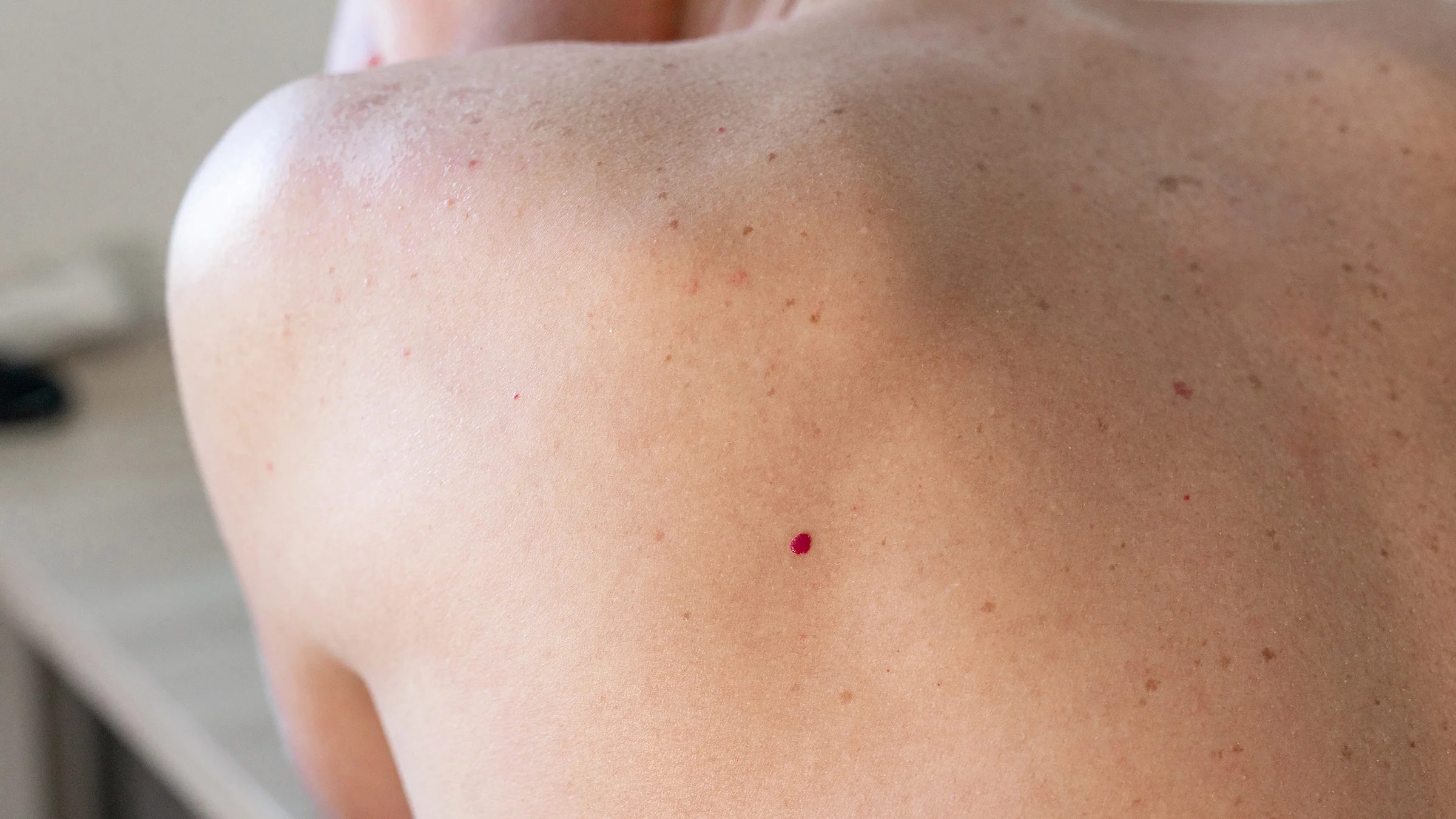 Close-up view of a cherry angioma on the upper back