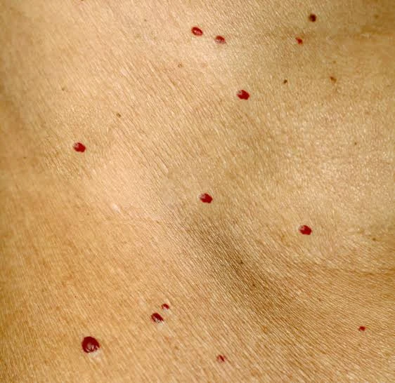 Multiple small red cherry angiomas on skin