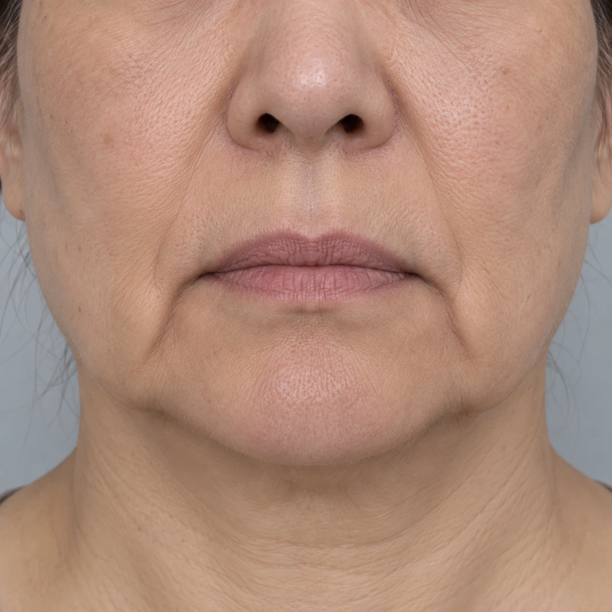 Lower-face close-up showing fullness beside the chin along the jawline.
