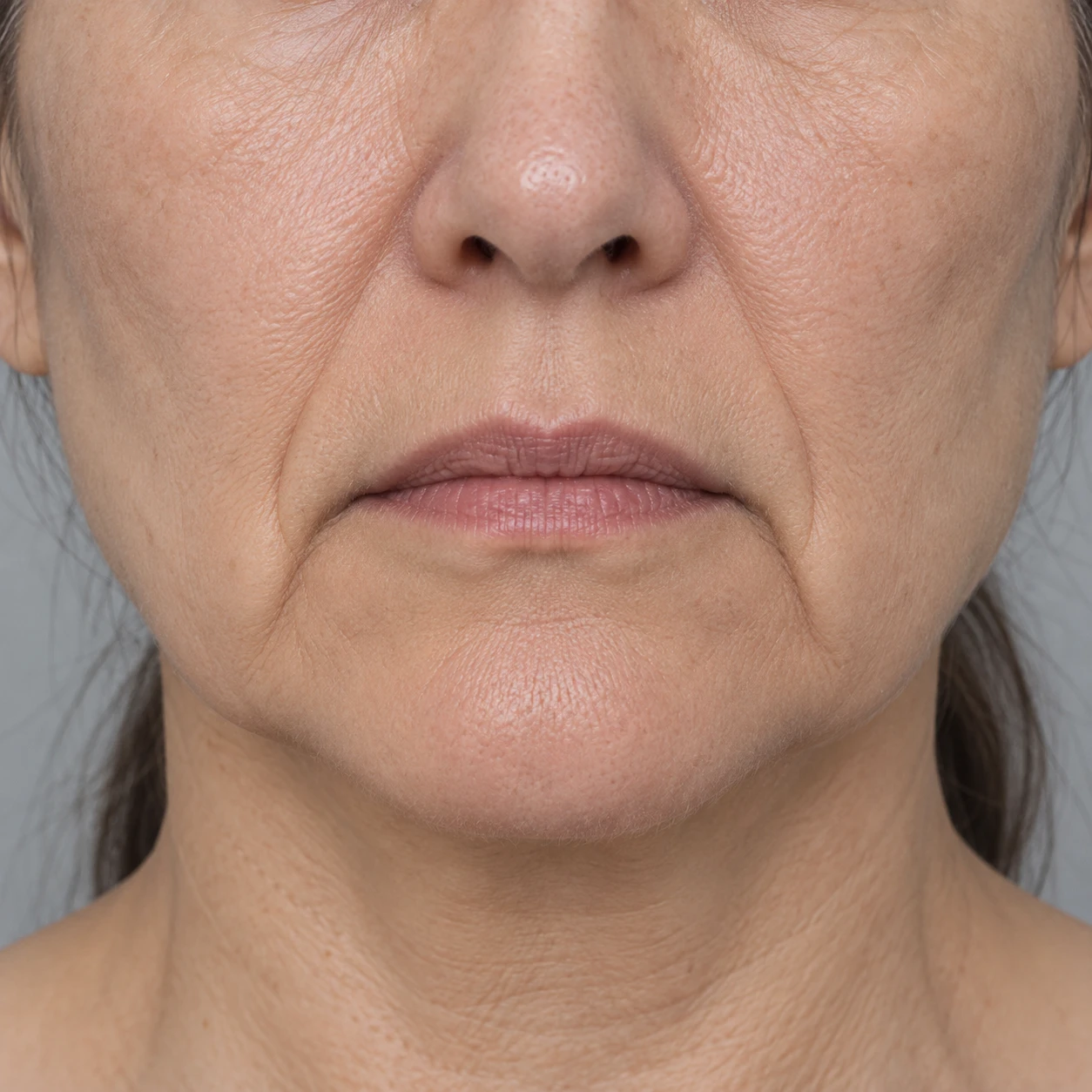 Lower-face close-up showing folds below the mouth corners towards the chin.